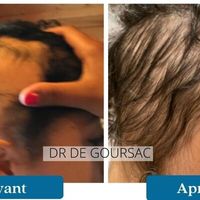 La chute des cheveux à deux vitesses : Carboxythérapie et casque LEDs vs Facteurs de croissance et casque LEDs