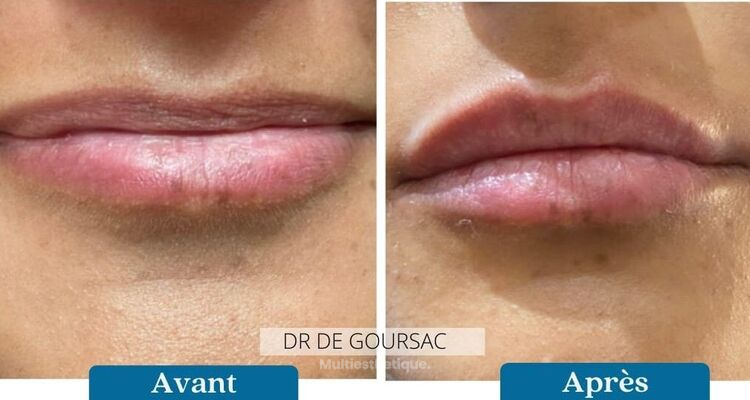 Les lèvres, l'une des caractéristiques les plus expressives et féminines du visage