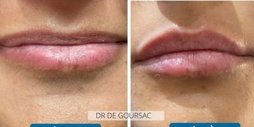 Les lèvres, l'une des caractéristiques les plus expressives et féminines du visage