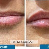 Les lèvres, l'une des caractéristiques les plus expressives et féminines du visage