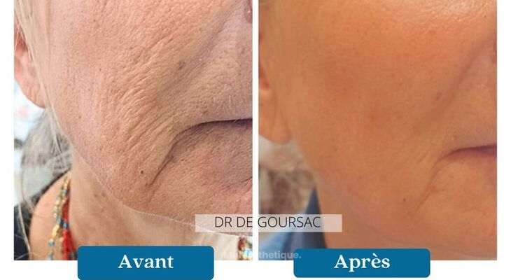 Une réponse à l'excès