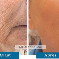 Une réponse à l'excès