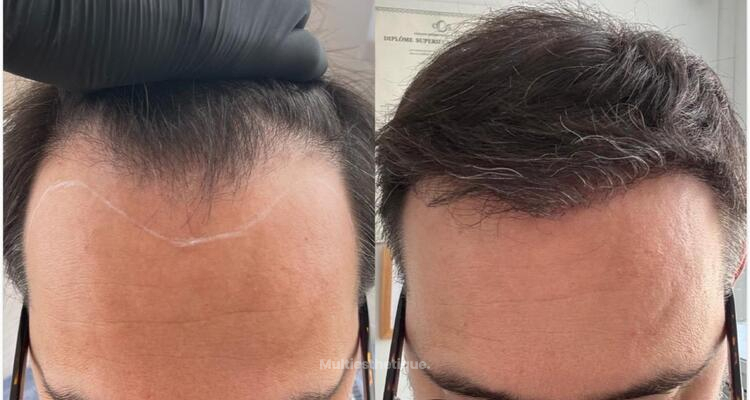 La greffe de cheveux FUE : expertise et résultats naturels chez CLEO Bordeaux