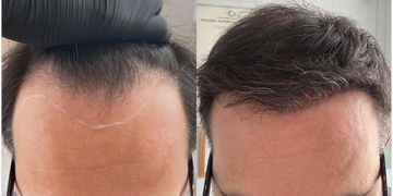 La greffe de cheveux FUE : expertise et résultats naturels chez CLEO Bordeaux
