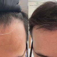 La greffe de cheveux FUE : expertise et résultats naturels chez CLEO Bordeaux