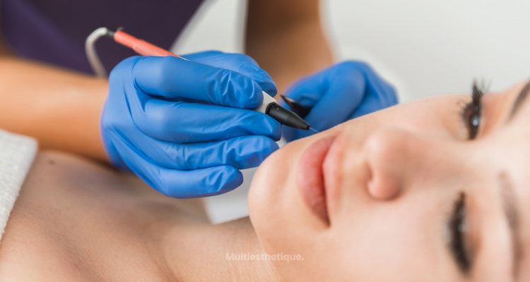 Épilation Électrique : La solution permanente pour une peau lisse et sans poils