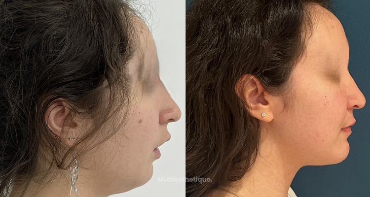 La chirurgie orthognathique : quand l’harmonie crée la beauté