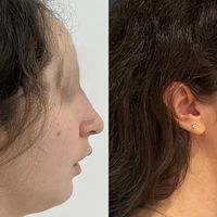 La chirurgie orthognathique : quand l’harmonie crée la beauté