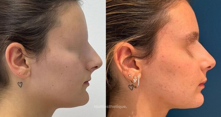 Chirurgie Orthognathique: ¡quand l’harmonie crée la beauté!