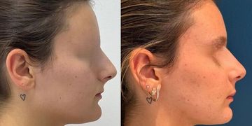 Chirurgie Orthognathique: ¡quand l’harmonie crée la beauté!