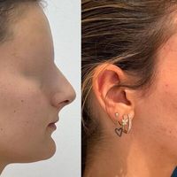 Chirurgie Orthognathique: ¡quand l’harmonie crée la beauté!
