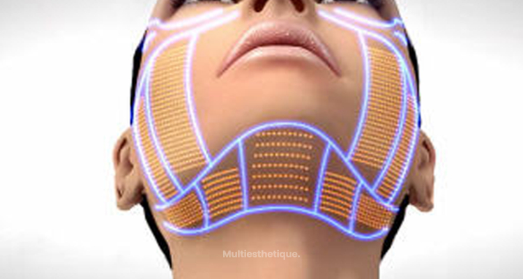 Tout sur l'Ulthera Lift