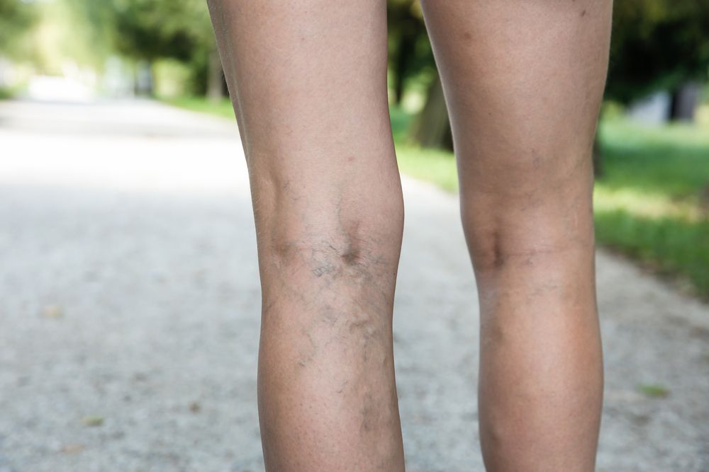 varices-tous-les-traitements-photo-2.jpg
