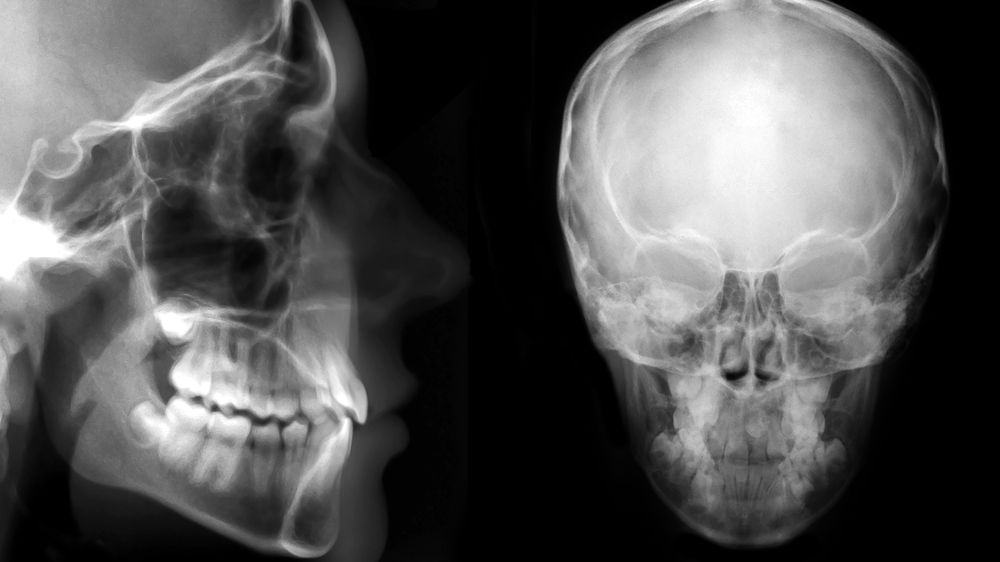 chirurgie-orthognatique-photo-3.jpg