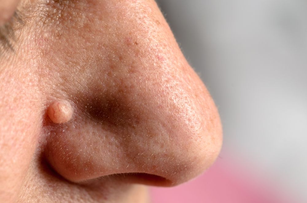 verrue sur le nez