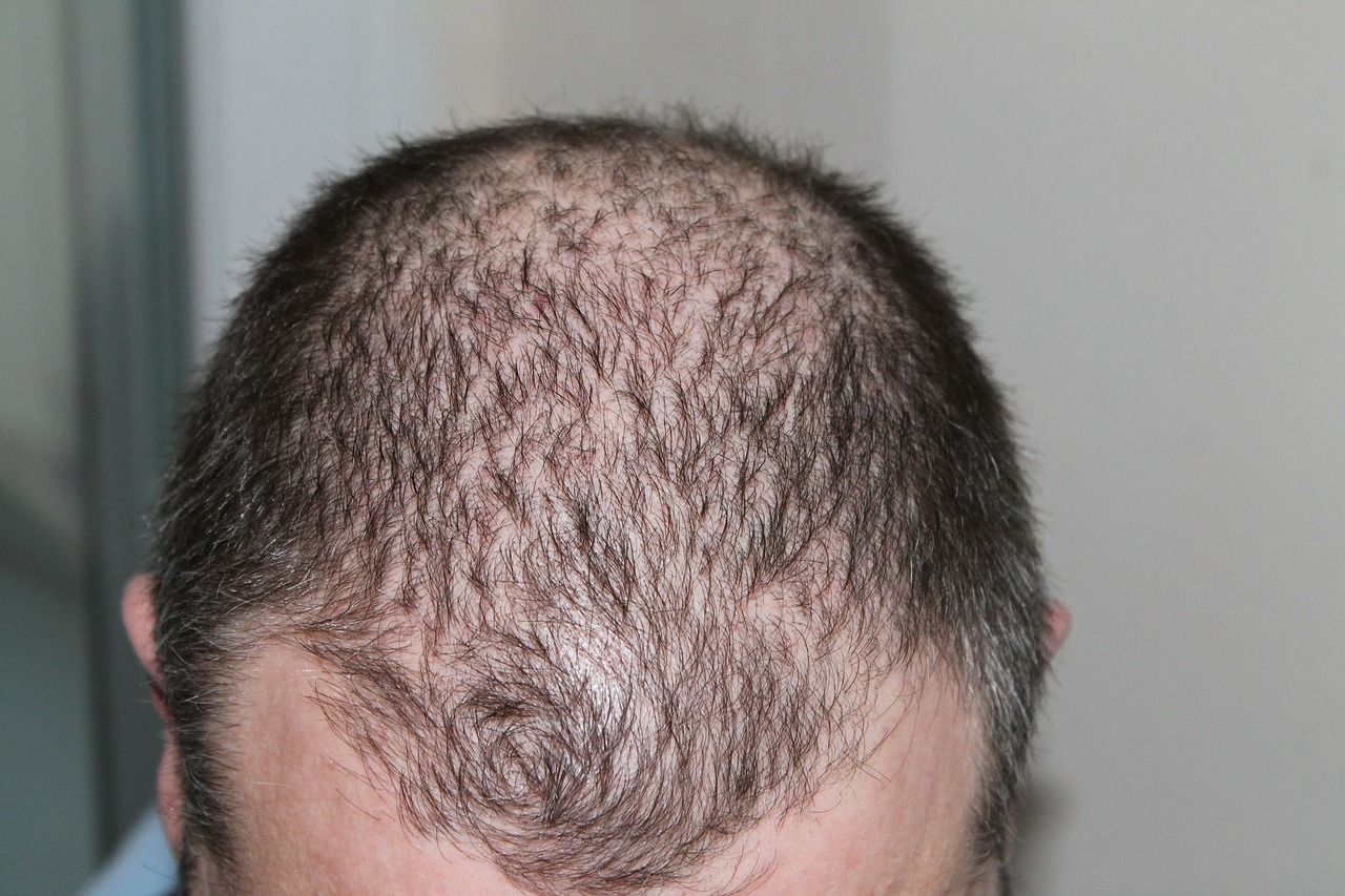 greffe-de-cheveux-photo-2.jpg