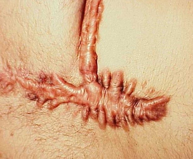 cicatrice-hypertrophique.jpg