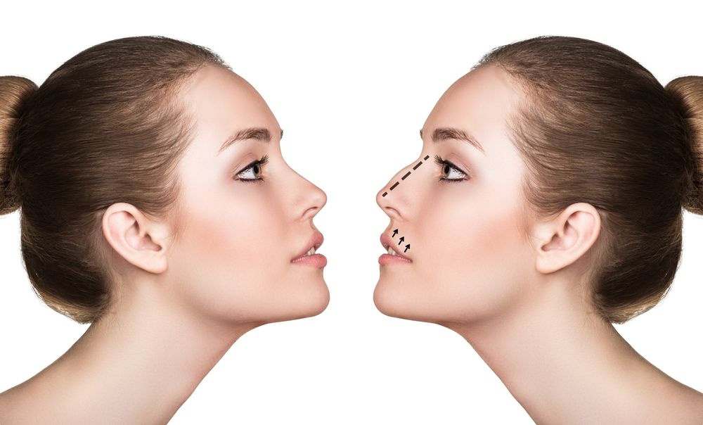 rhinoplastie-soins-photo-3.jpg