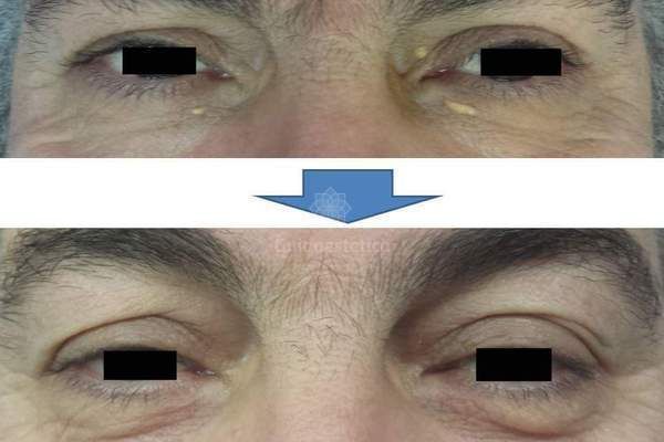 xanthelasma.jpg