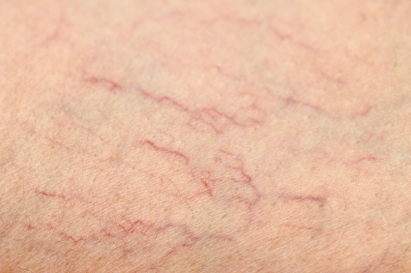 Varices