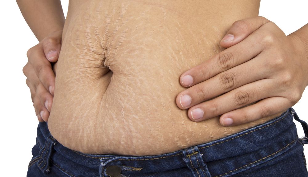 estria-abdominal.jpg
