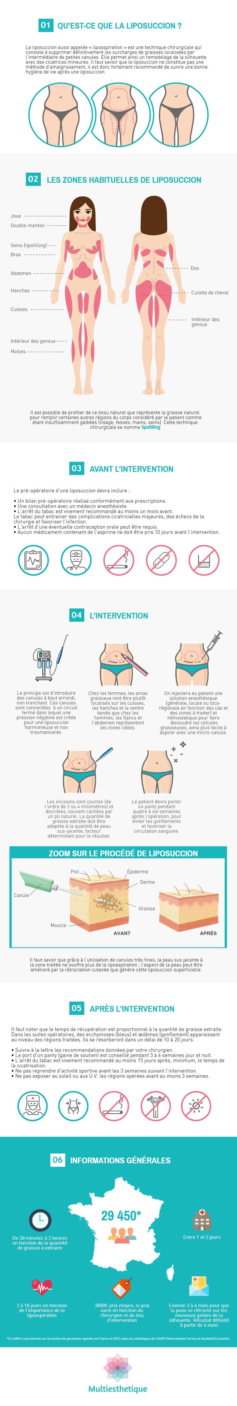 La liposuccion Tout savoir sur la lipoaspiration Multiesthetique.fr
