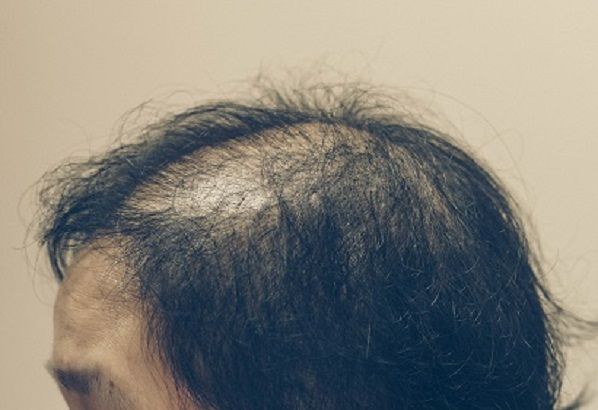 alopecia.jpg