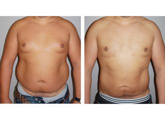 Cabinets De Liposuccion A Ecully Multiesthetique Fr
