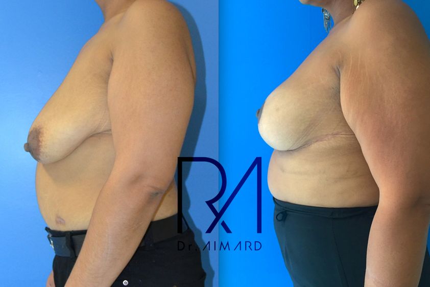 Lipofilling avant et après - 635348