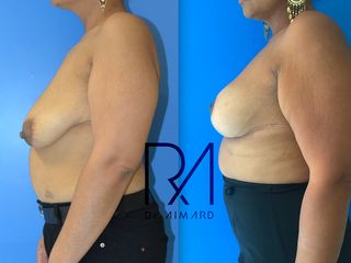 Avant après Pexie (lifting mammaire) + Lipofilling