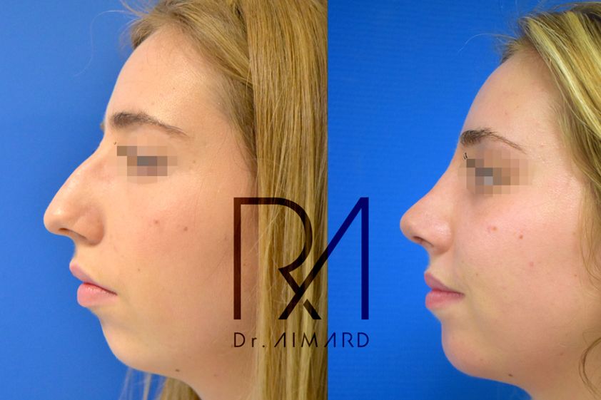 Rhinoplastie avant et après - 635792