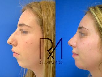 Rhinoplastie - 635792