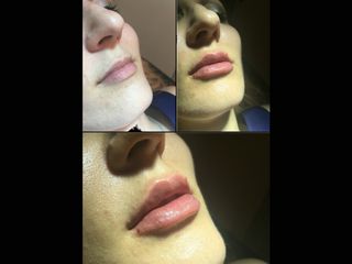 Avant après Augmentation des lèvres