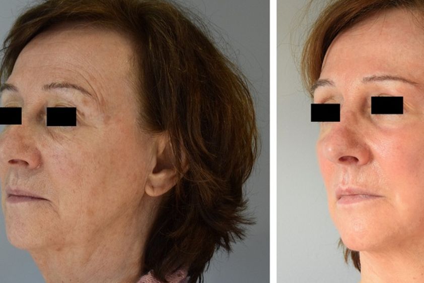 Peeling avant et après - 537148