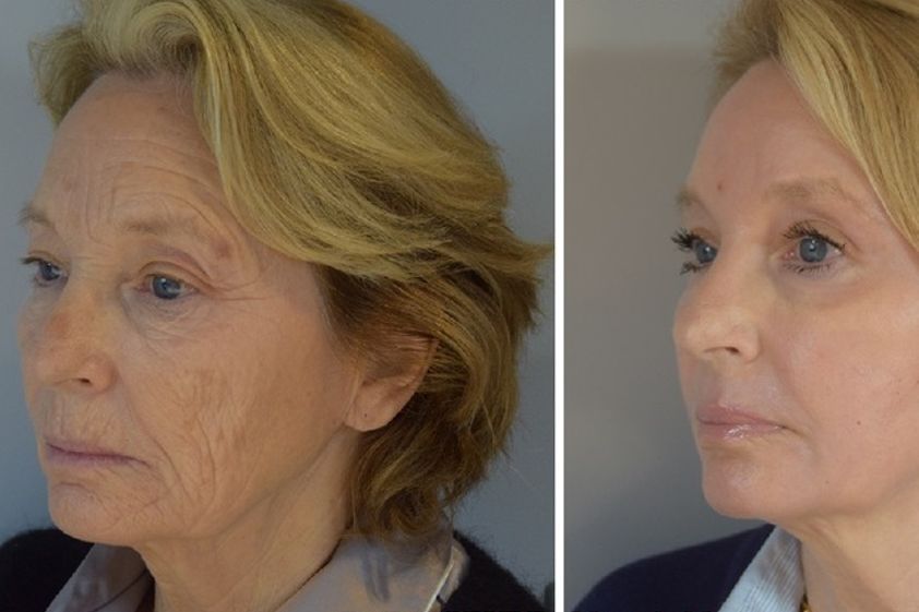 Peeling avant et après - 586013
