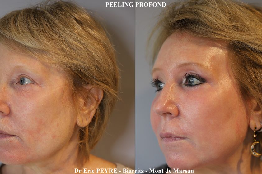 Peeling avant et après - 740691
