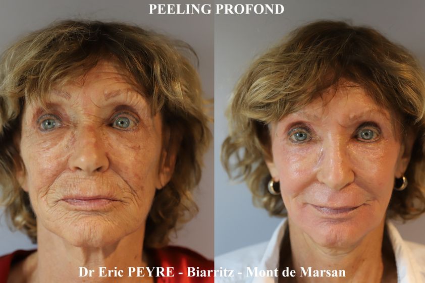 Lifting sans chirurgie avant et après - 838839