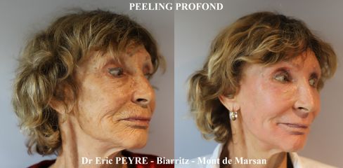 Peeling Profond - Dr Eric Peyre