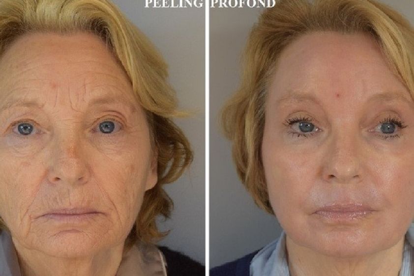 Lifting sans chirurgie avant et après - 840745