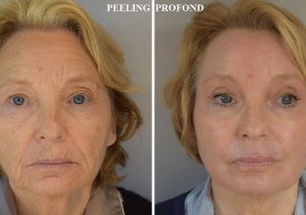 Peeling profond - Dr Eric Peyre