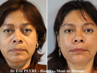 Lifting sans chirurgie avant et après - 853989