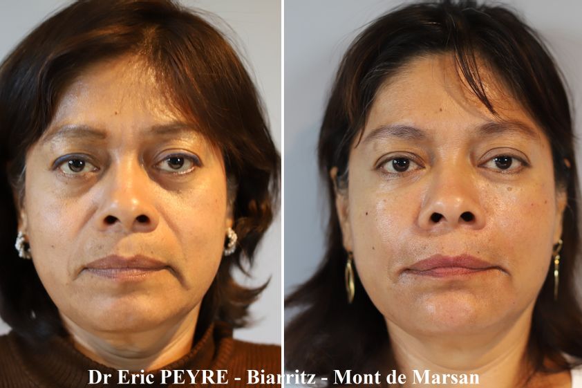 Lifting sans chirurgie avant et après - 853989