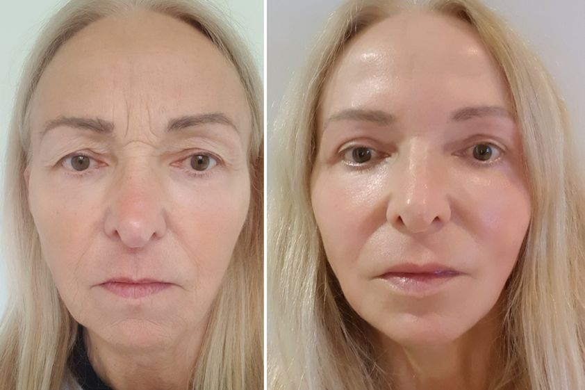 Lifting sans chirurgie avant et après - 871161