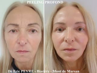 PEELING PROFOND - Dr Eric Peyre