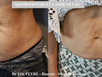 Lifting sans chirurgie avant et après - 875904