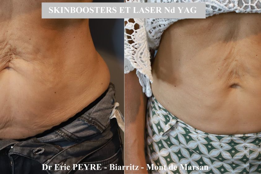 Lifting sans chirurgie avant et après - 875904