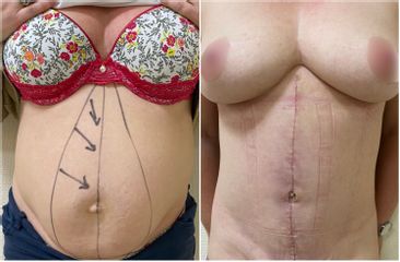 Abdominoplastie - Dr Pascal Chantereau