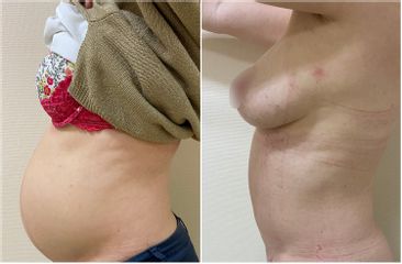 Abdominoplastie - Dr Pascal Chantereau