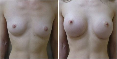 Augmentation mammaire - Dr Pascal Chantereau
