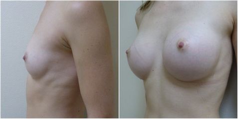 Augmentation mammaire - Dr Pascal Chantereau